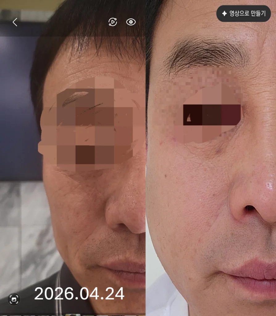 Calix + Regenew+1 Clinical Case — Before / After