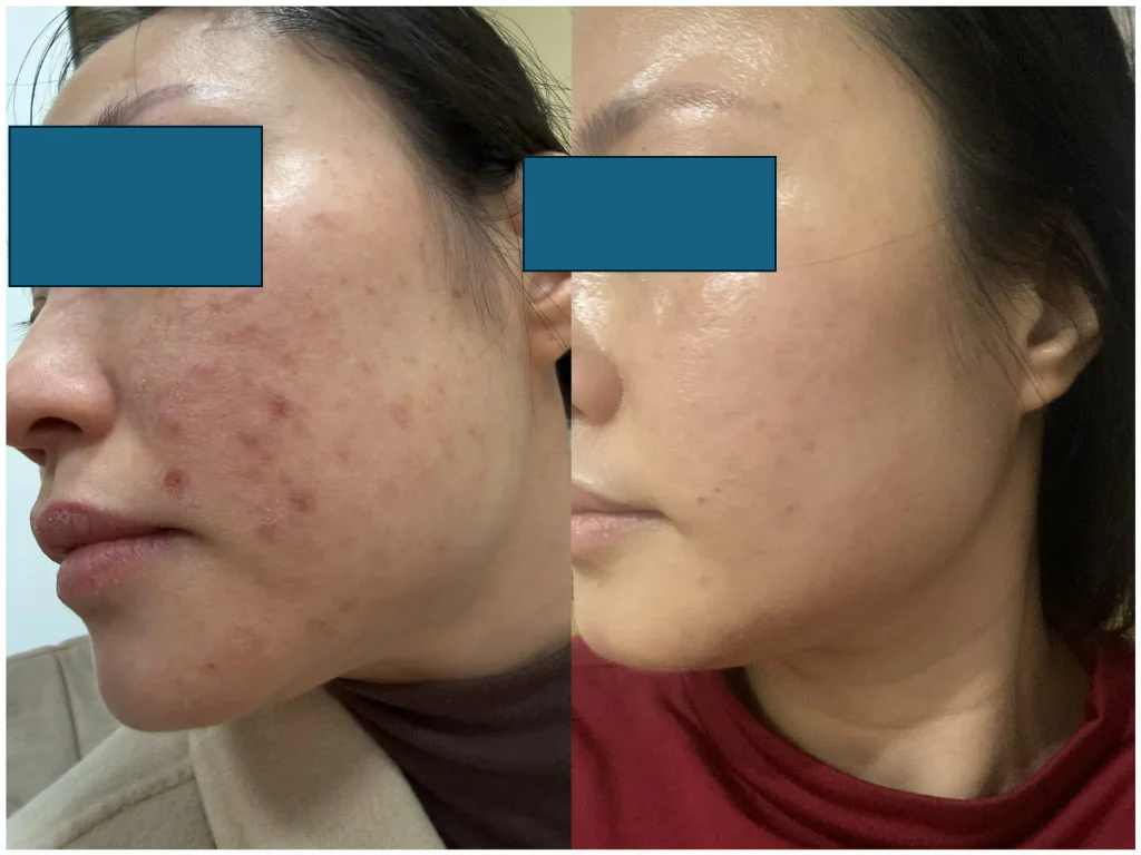 Regenew+1 → Regenew+2 Clinical Case — Trouble Skin Before / After
