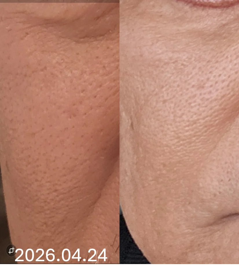 Regenew+1 Clinical Case — Before / After